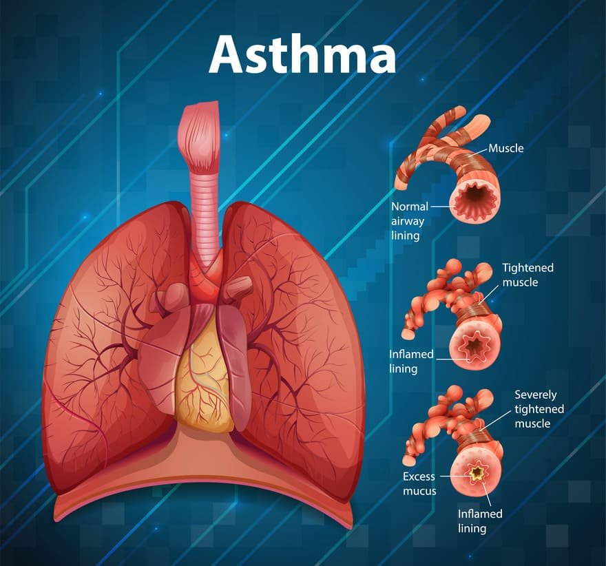 Asthma Diagnosis and Management