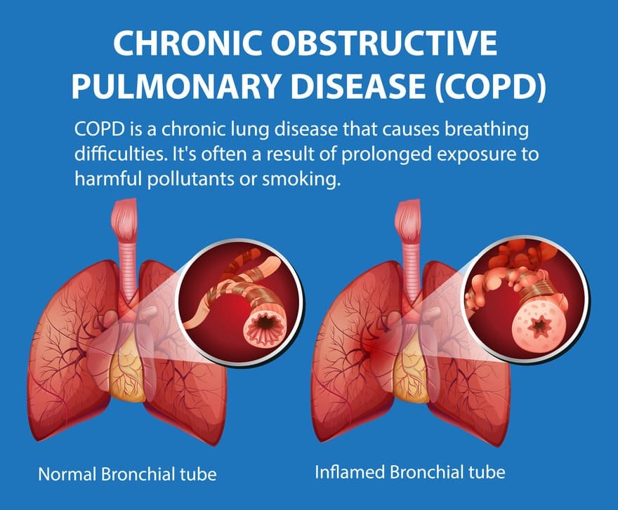 COPD Management