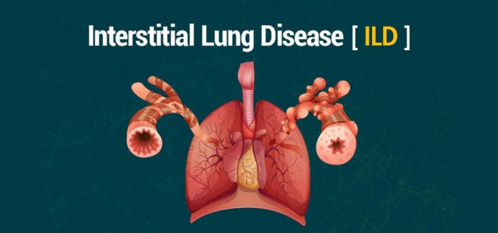 Interstitial Lung Disease Treatment