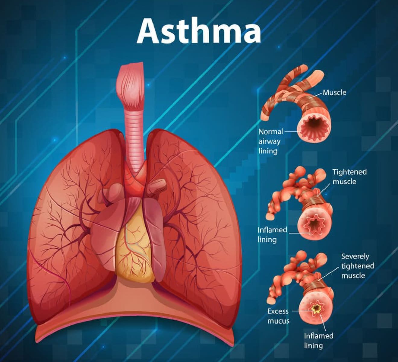 Asthma Diagnosis