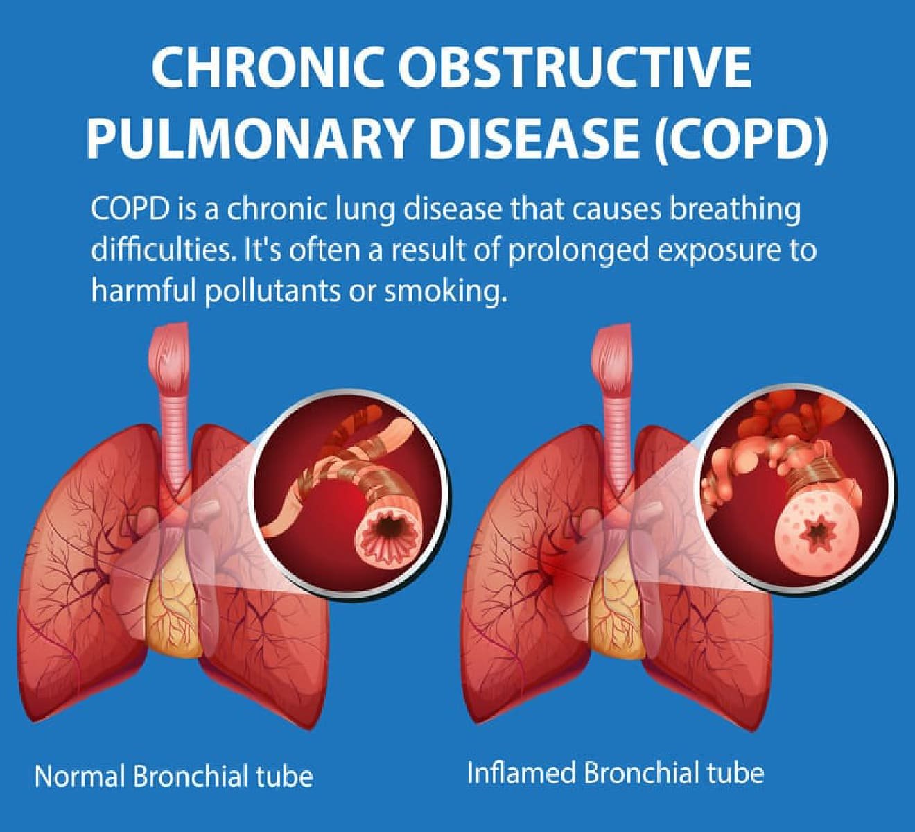 COPD