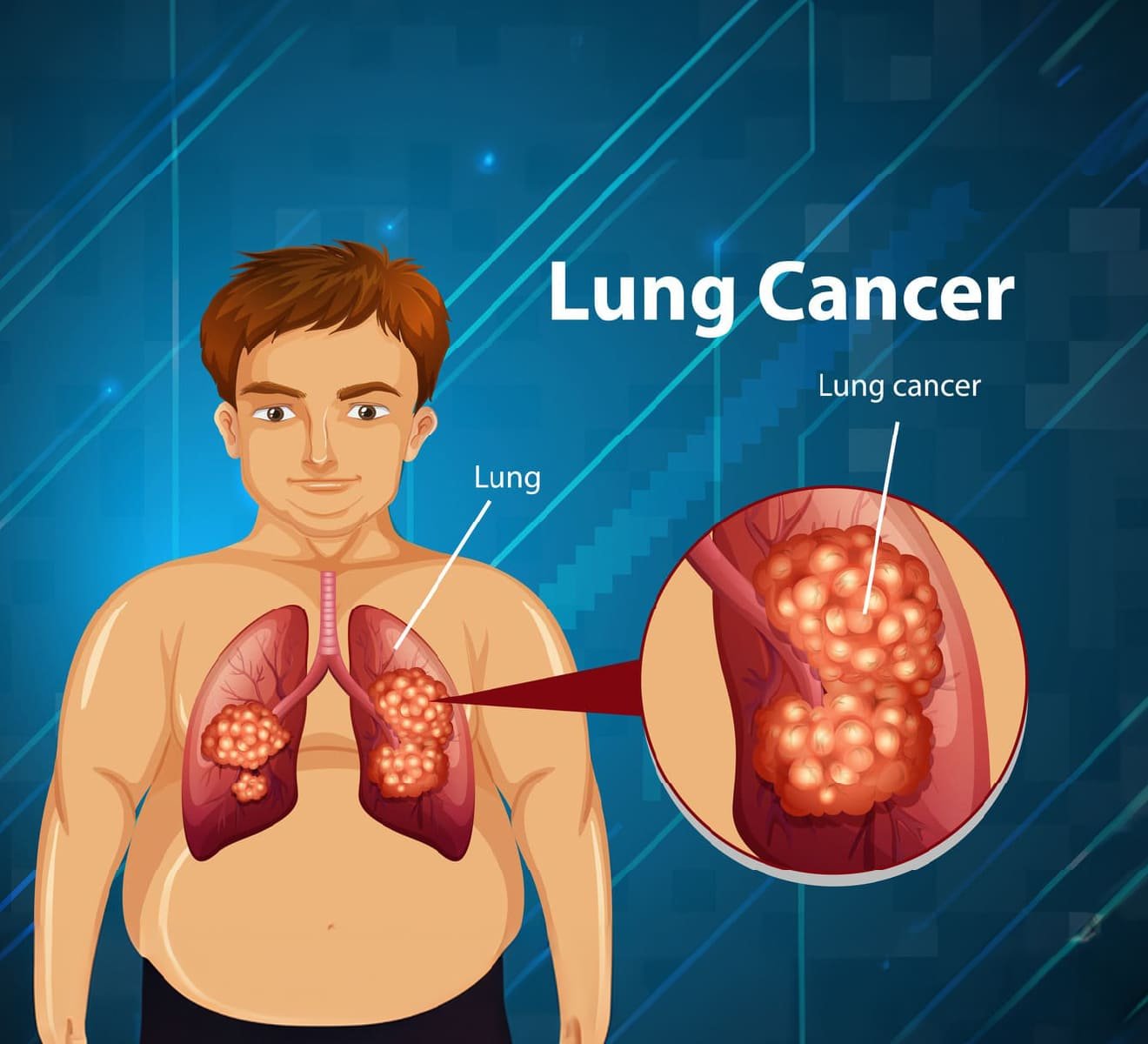 Lung Cancer