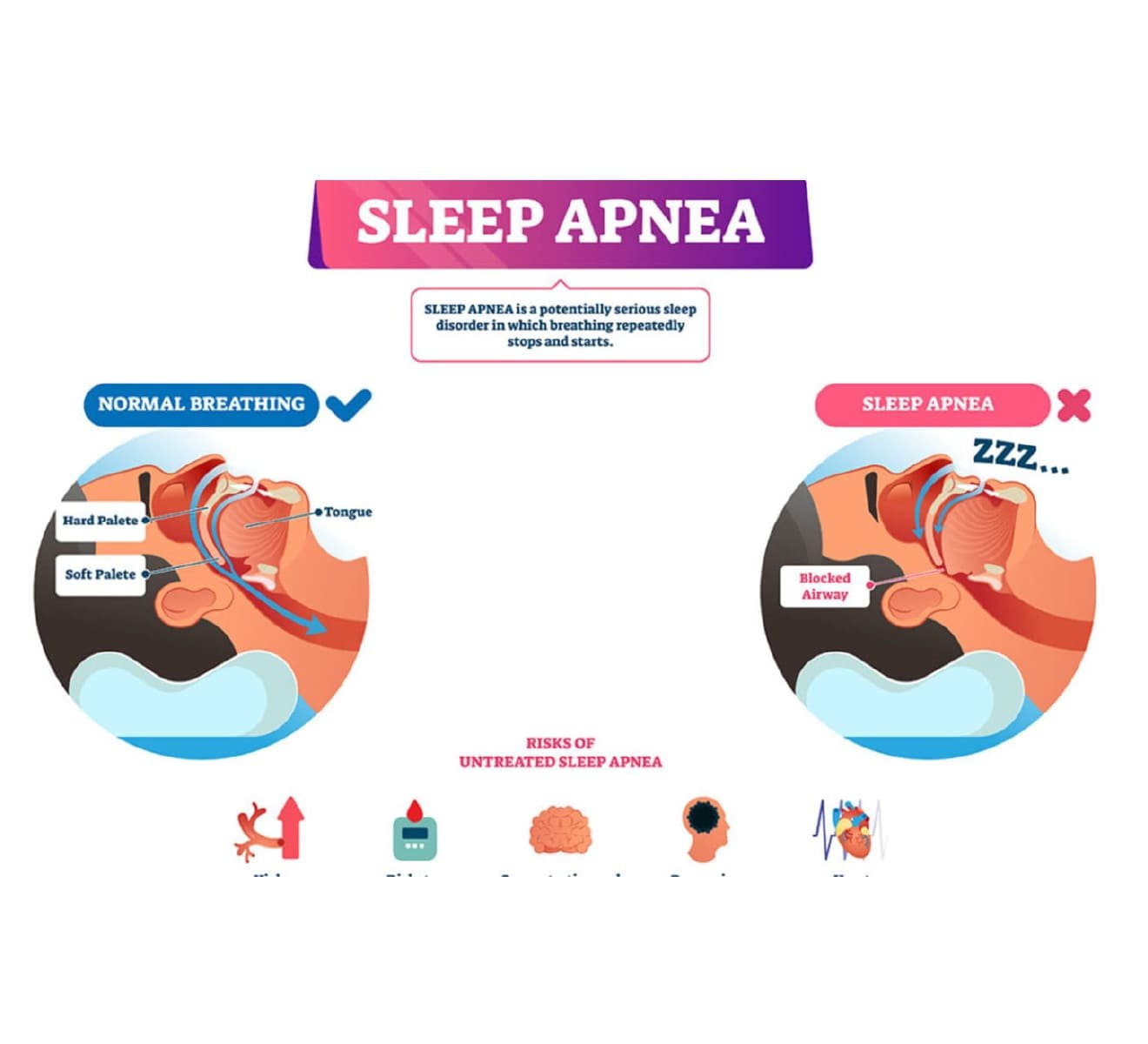 Sleep Apnea