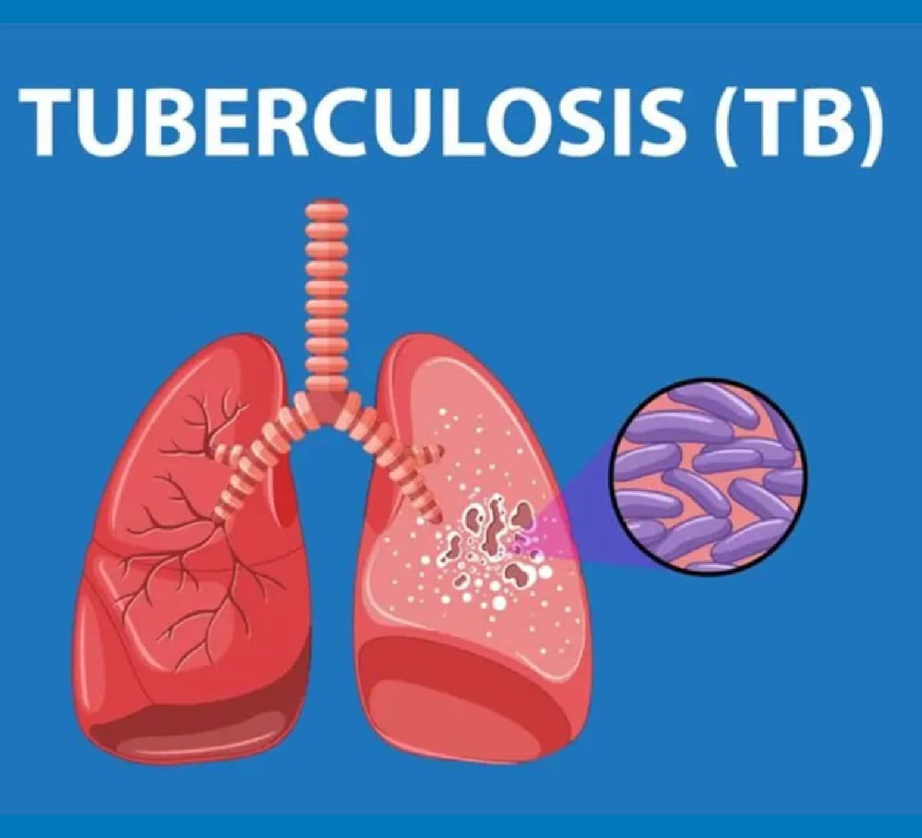 Tuberculosis