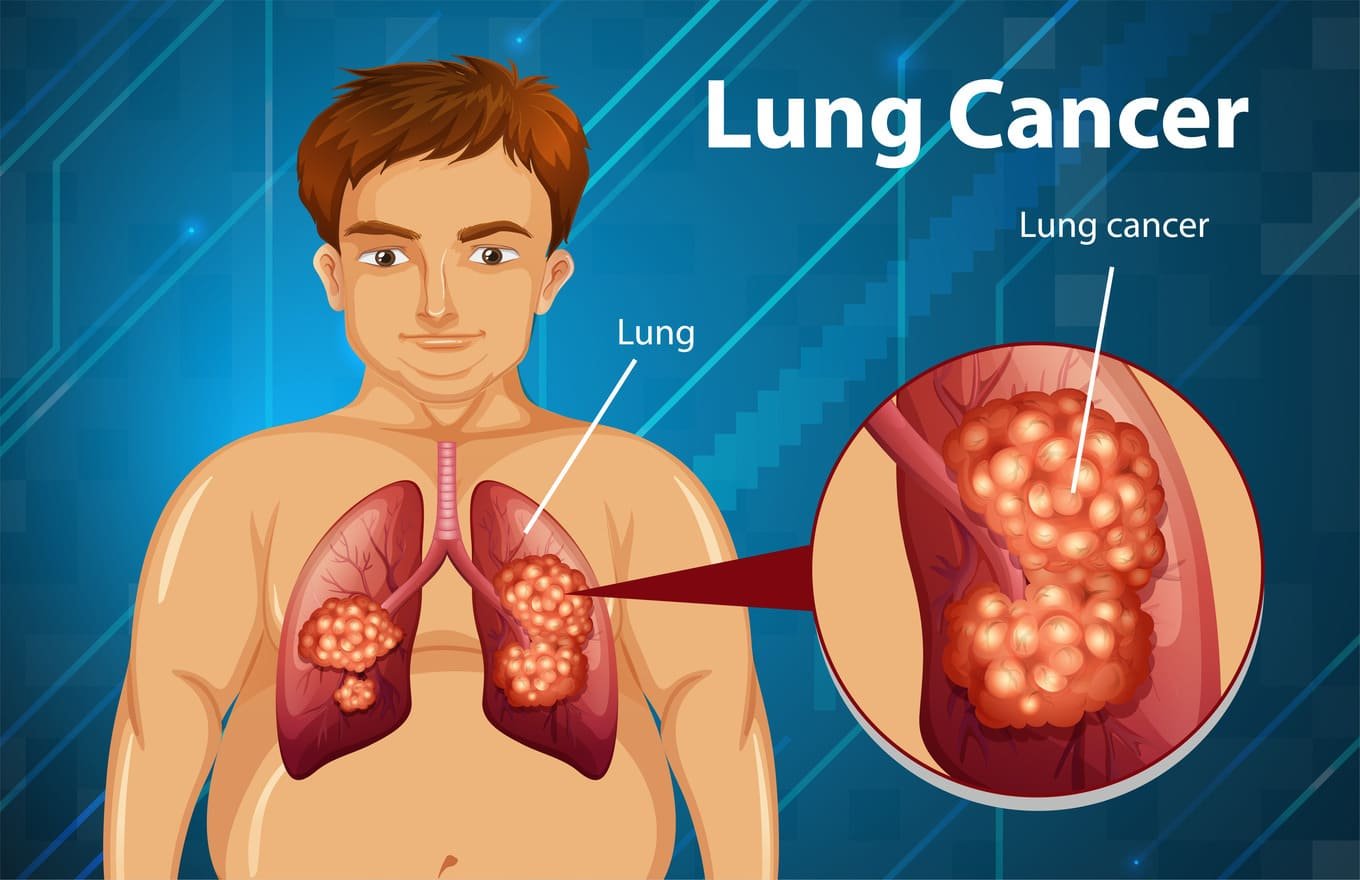 Lung Cancer Management