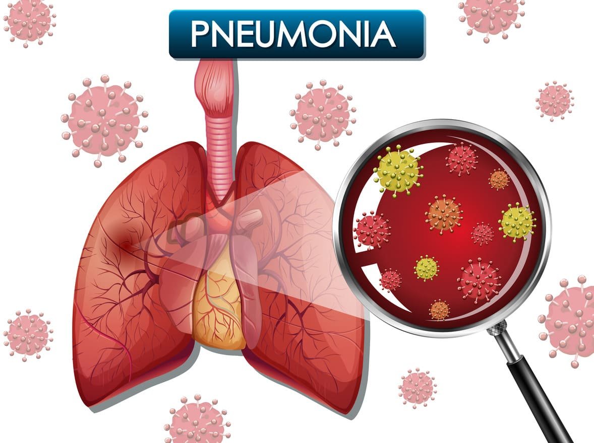 Lung Infections and Pneumonia Treatment