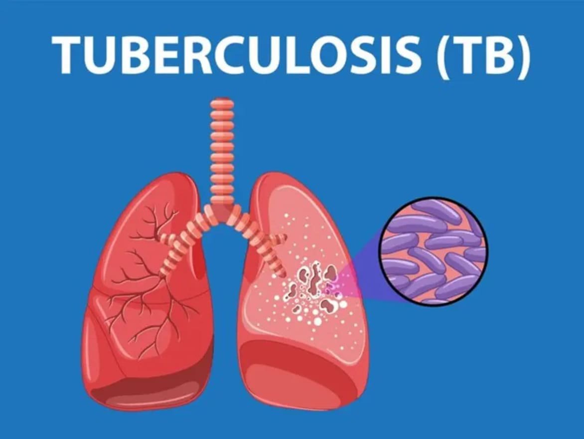 Tuberculosis Diagnosis and Treatment